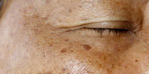 fade harder pigmentation